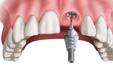 Những nguy cơ gây mất an toàn khi trồng răng implant hàm trên