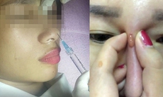 Bác sĩ cảnh báo những biến chứng sau tiêm filler nâng ngực, mũi, xóa nhăn...