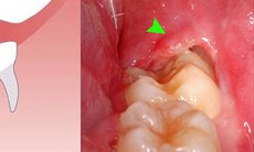 Viêm lợi trùm có thực sự đáng lo?