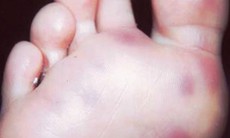 Viêm tuyến mồ hôi bàn chân tự phát có điều trị được không?