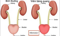 Viêm bàng quang và các biến chứng nguy hiểm