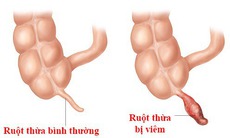 Cần phẫu thuật ruột thừa ngay khi bị viêm, ai cũng biết nhưng lại không hiểu