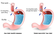 Những bất lợi có thể gặp khi dùng thuốc điều trị trào ngược dạ dày thực quản