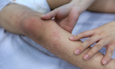 Sốt xuất huyết - dấu hiệu nhận biết và cách cắt sốt nhanh