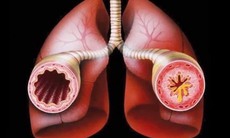 Khí dung salbutamol nhiều cho trẻ bị hen có sao không?