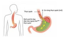 Hỗ trợ giảm triệu chứng trào ngược dạ dày thực quản hiệu quả - tiết kiệm