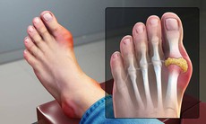 Sưng đau khớp ngón chân cái là bệnh gì, có nguy hiểm không?