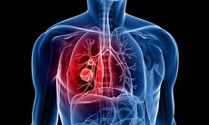 Chẩn đoán ung thư phổi bằng cách nào?