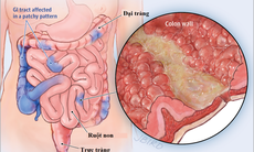 Liệu pháp mới trong điều trị bệnh Crohn