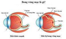 Bong võng mạc – Căn bệnh nên lưu ý ở mắt cận thị cao