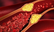 Phát triển thuốc mới giảm cholesterol máu