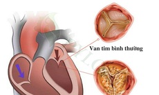 Vôi hóa van tim có nguy hiểm?