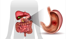 Làm lành dạ dày - Nguyên tắc quan trọng trong hỗ trợ điều trị viêm loét - vi khuẩn HP