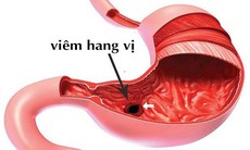 Viêm - loét hang vị dạ dày hỗ trợ bằng thảo dược được không?