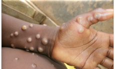 Bệnh đậu mùa khỉ ở trẻ em khá hiếm gặp và ít nghiêm trọng