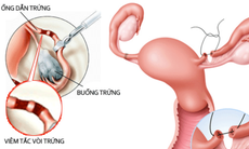 Nguyên nhân nào gây ra tình trạng hiếm muộn ở nữ giới?