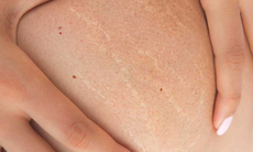 Cách trị rạn da hiệu quả tại nhà ít người biết