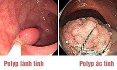 Khi nào polyp đại trực tràng thành ác tính?