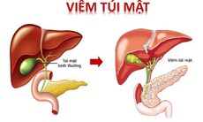 6 huyệt vị hỗ trợ điều trị viêm túi mật