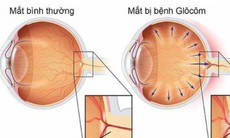 Các thuốc nhỏ mắt dùng trong điều trị Glaucom