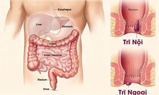 Bệnh trĩ đâu còn là nỗi lo - giải pháp hỗ trợ từ thảo dược tự nhiên