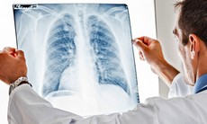 Các thuốc và phương pháp điều trị ung thư phổi