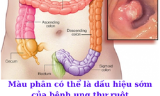 Thay đổi thói quen đi đại tiện có thể là dấu hiệu cảnh báo bệnh ung thư ruột