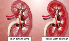 3 bài thuốc hỗ trợ điều trị viêm cầu thận cấp tính