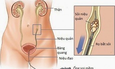 Kỹ thuật tán sỏi tiết niệu ngoài cơ thể bằng laser và những lưu ý cho người bệnh