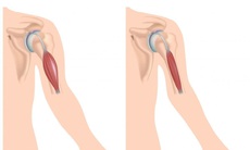 Bệnh loạn dưỡng cơ nguy hiểm thế nào, có thuốc điều trị khỏi bệnh không?