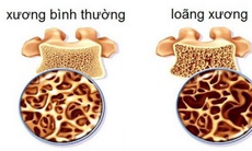 Dừng uống thuốc bảo vệ xương, có thể làm tăng nguy cơ gãy xương