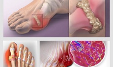 Bệnh gout cấp: Biểu hiện, diễn biến và những lưu ý khi thời tiết lạnh