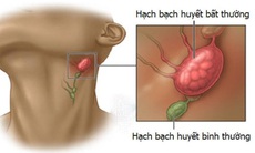 Tăng nguy cơ tử vong ở người ung thư hạch bạch huyết khi dùng ukoniq