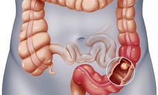 Polyp đại trực tràng: Nguyên nhân, phương pháp điều trị và phòng ngừa