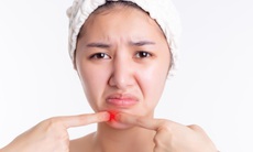 Mụn đinh râu: Nguyên nhân và triệu chứng