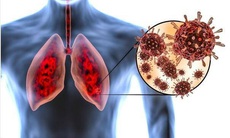 Khó thở dai dẳng là dấu hiệu tổn thương phổi ở bệnh nhân mắc COVID-19