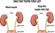 Ung thư tuyến tiền liệt và những hiểu lầm thường gặp