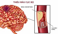 Phòng nguy cơ cục máu đông, di chứng thần kinh hậu COVID-19 bằng y học cổ truyền