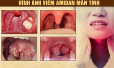 Viêm amidan mạn tính là gì? Cách điều trị và phòng ngừa tái phát