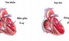 Một số lưu ý khi dùng thuốc điều trị triệu chứng suy tim