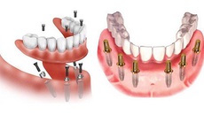 Phương pháp trồng răng Implant toàn hàm All-On-6