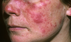 Triệu chứng điển hình của lupus ban đỏ và cách hỗ trợ