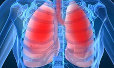Viêm phổi khi mang thai gây nhiều biến chứng nguy hiểm nhưng có thể phòng ngừa