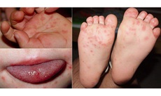 Chữa bệnh tay chân miệng bằng đông y