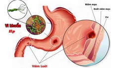 Người bệnh nhiễm vi khuẩn H.Pylori có thêm phương pháp chữa trị