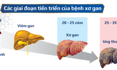 Nhận biết nguyên nhân, triệu chứng xơ gan và giải pháp hỗ trợ bảo vệ tế bào gan