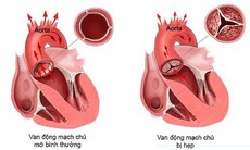 Hẹp van động mạch chủ và các lựa chọn điều trị