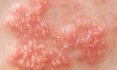 Nhận biết và phòng ngừa Herpes sinh dục