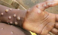 12 quốc gia ghi nhận bệnh đậu mùa khỉ, Việt Nam theo dõi sát sao, giám sát chặt