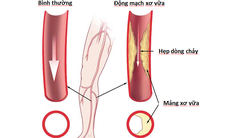 Hoại tử nặng vì đắp lá chữa tắc động mạch chi dưới